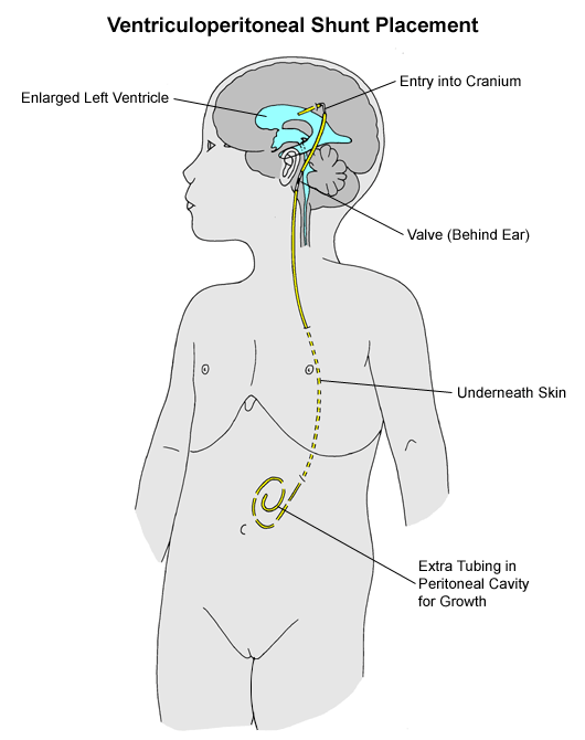 Diagram of VP Shunt